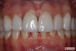 Ostateczne licówki caoceramiczne osadzone na zębach w odcinku przednim