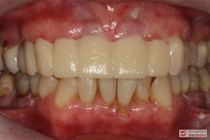 Mock-up w ustach - zęby w zwarciu, kompozytowa wizualizacja przyszłej rekonstrukcji w łuku górnym