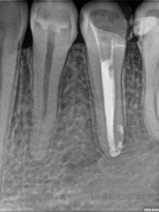 Leczenie kanałowe drugiego przedtrzonowca - status po 10 miesiącach