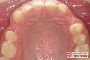 Widok powierzchni okluzyjnej zębów w szczęce – pojedyncze braki zębowe