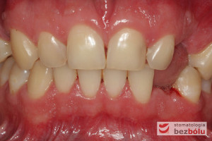 Uzębienie pacjenta - widok z przodu