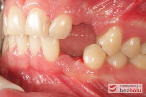 Uzębienie pacjenta - strona lewa - w takim razie przydałaby się też prawa