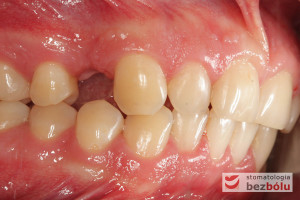 Uzębienie pacjenta - strona prawa