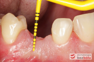 Pomiar szerokości dziąsła zrogowaciałego 