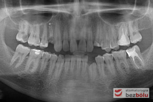 Zdjęcie ortopantomograficzne przed rozpoczęciem leczenia - widoczne złamane kły po stronie prawej i wymagający usunięcia z powodu zniszczenia korony ząb 14