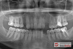 Stan po usunięciu zębów i wygojeniu zębodołów