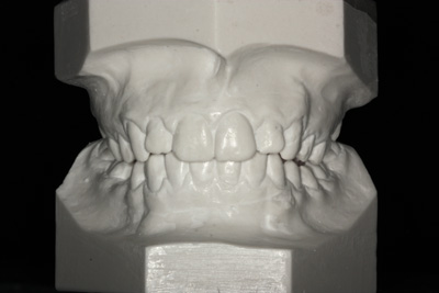 Modele diagnostyczne w ortodoncji