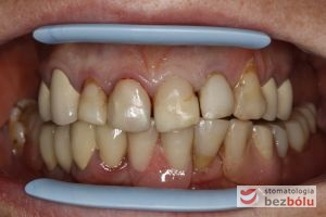 Zęby górne i dolne w zwarciu - pełne łuki - widoczny nieregularny kształt siekaczy górnych, przebarwienia i nawisające wypełnienia