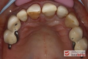 Widok powierzchni zgryzowej zębów w szczęce - zęby sieczne odbudowane kompozytem, przedtrzonowce i kieł pokryte koronami porcelanowymi