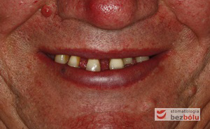 Pozytywna przemiana uśmiechu - odbudowa protetyczna na implantach - obraz kliniczny przed terapią stomatologiczną