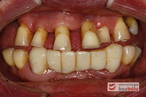 Stan wyjściowy - patologiczne wychylenie zębów górnych, liczne braki zębowe w szczęce i żuchwie, nieproporcjonalnie małe zęby do podstaw kostnych