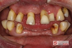 Stan wyjściowy - patologiczne wychylenie zębów górnych, liczne braki zębowe w szczęce i żuchwie, nieproporcjonalnie małe zęby do podstaw kostnych