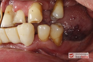 Braki zębowe w strefach bocznych szczęki i żuchwy - widoczne starcie patologiczne na skutek przeciążeń okluzyjnych w odcinku przednim