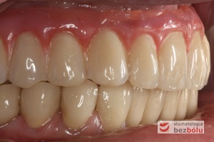 Ostateczny efekt estetyczny wieńczący proces terapeutyczny - odbudowa protetyczna obu łuków zębowych przy zastosowaniu implantów Friadent Ankylos