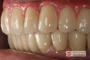 Ostateczny efekt estetyczny wieńczący proces terapeutyczny - odbudowa protetyczna obu łuków zębowych przy zastosowaniu implantów Friadent Ankylos