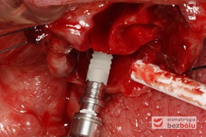 Wprowadzenie implantów - implant Ankylos umożliwia wprowadzenie pod wyrostek co zapewnia wysoką stabilizację
