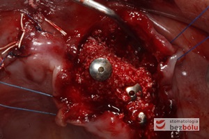 Wprowadzone implanty po stronie lewej - mini śruby wprowadzone w celu podtrzymania augumentatu i utrzymania przestrzeni dla nowej kości