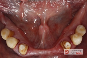 Żuchwa - widok powierzchni okluzyjnej - symetryczne braki zębowe w zakresie 4 siekaczy i trzonowców