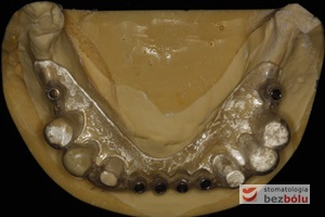 Model gipsowy żuchwy z szablonem chirurgicznym - metalowe tuleje wyznaczają miejsce wprowadzenia wszczepów - widoczne w obrazie RTG