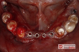Szablon chirurgiczny oparty o zęby żuchwy - miejsca dla implantów siekaczy wyznaczają tuleje