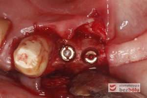 Wprowadzenie 4 implantów w odcinku przednim żuchwy