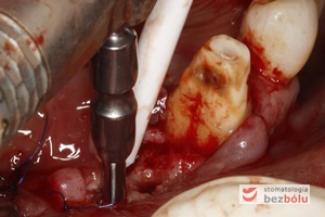 Wprowadzenie 4 implantów w odcinku przednim żuchwy
