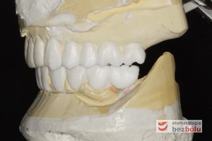 Modele gipsowe z wax-up'em - technik dentystyczny kreuje przyszły kształt zębów za pomocą wosku naniesionego na model