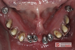Transfery wyciskowe przykręcone do implantów - zęby własne opracowane jako filary pod korony całoceramiczne - skoagulowane dziąsła brzeżne