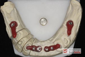 Indywudalizowane filary protetyczne z żywicznymi kluczami - czerwone klucze pattern-resin wyznaczają dokładną pozycję łącznika względem zębów sąsiednich