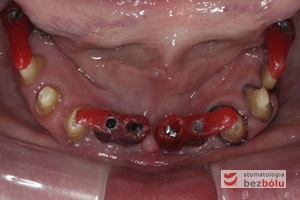 Indywudalizowane filary protetyczne z żywicznymi kluczami - czerwone klucze pattern-resin wyznaczają dokładną pozycję łącznika względem zębów sąsiednich