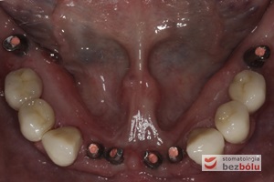Wprowadzenie gotowych koron na zęby i implanty - śruby łączników tytanowych zamknięte różową gutaperką