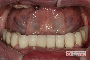 Wprowadzenie gotowych koron na zęby i implanty - śruby łączników tytanowych zamknięte różową gutaperką