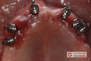 Proces pobierania wycisków - transfery wyciskowe do łyżki otwartej przykręcone do implantów