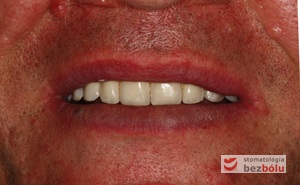 Pozytywna przemiana uśmiechu - odbudowa protetyczna na implantach - obraz kliniczny po terapii stomatologicznej