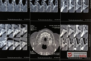 Radiologiczny obraz jamy ustnej z wykorzystaniem tomografu - precyzyjne pozycjonowanie lokalizacji planowanych implantów