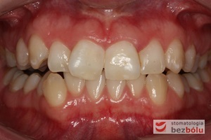 Widok zębów górnych i dolnych w zwarciu od przodu