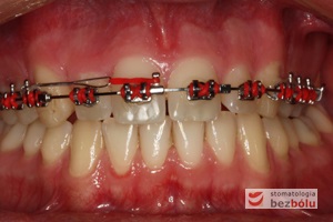 Etap zamykania luki po usuniętym zębie dodatkowym - zastosowana mechanika typu ti-back