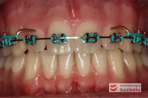 Etap kształtowania łuku i domykania szpar między zębami zastosowany łuk typu posted