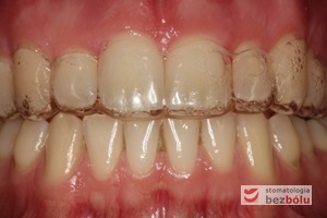 Szyna utrwalająca efekty lecznia osadzona na zębach