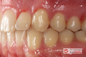 Zęby w zwarciu po leczeniu - strona lewa