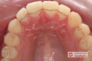 Utrwalenie efektów leczenia i pozycji prawidłowej zębów przy pomocy reteinera stałego klejonego do powierzchni podniebiennych siekaczy i kłów