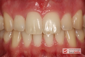 Zęby górne i dolne w zwarciu - efekt po leczeniu