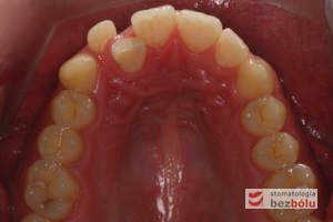Zęby górne - powierzchnie okluzyjne