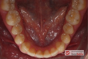 Zęby dolne -  powierzchnie okluzyjne