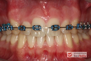 Faza początkowa leczenia ortodontycznego