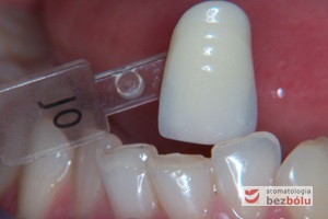 Dobór koloru przyszłych koron - dobór koloru do zębów przeciwstawnych i sąsiednich oraz oczekiwań pacjentki