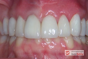 Ostateczny efekt terapeutyczny - widoczna poprawa efektu estetycznego przy jednoczesnym kamuflażu wad zębów