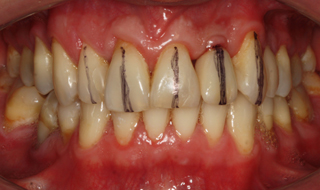 Wyznaczenie osi długich zębów w szczęce - implantoprotetyczne leczenie braków zębowych