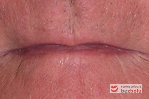 Dolny odcinek twarzy bezzębnego mężczyzny - charakterystyczne dla bezzębia zapadnięcie warg i bruzd nosowo-wargowych oraz policzków