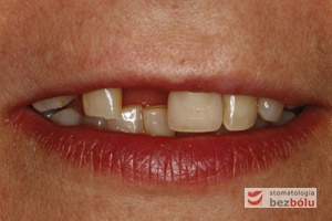 Pacjentka lat 55 o bardzo regularnych rysach twarzy - nieliczne pojedyncze braki zębowe - zachowane zęby zniszczone próchnicą